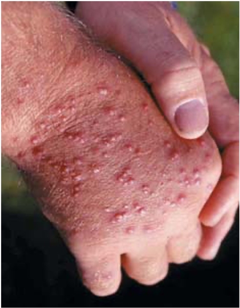 red, swollen pustules from ant stings covering the skin on a hand