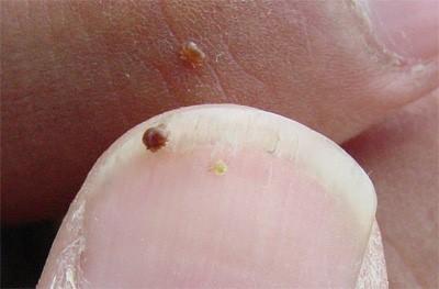 varroa mite on the tip of a fingernail